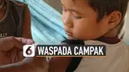 Wabah Campak di Samoa hingga merenggut 70 korban jiwa. Bayi dan anak-anak hingga lima tahun sangat rentan terjangkit campak.