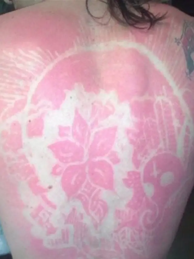 Sunburn Tattoo/Art