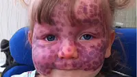 Matilda dilahirkan dengan sindrom yang membuat kulit tubuhnya berwarna keunguan dan berbintik polka dot. 