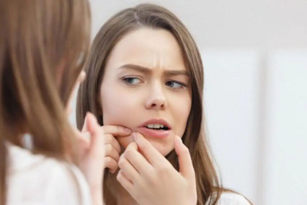 Duh jerawat ini memang menjengkelkan./Copyright shutterstock.com