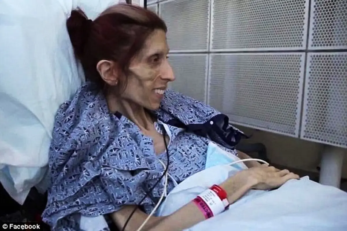 Rachael Farrokh, Penderita Anorexia yang Kini Kembali Ceria