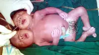Tragis, Bayi Terlahir Kembar Dua Kepala Satu Alat Kelamin