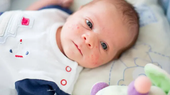 Ilustrasi Bayi Alergi