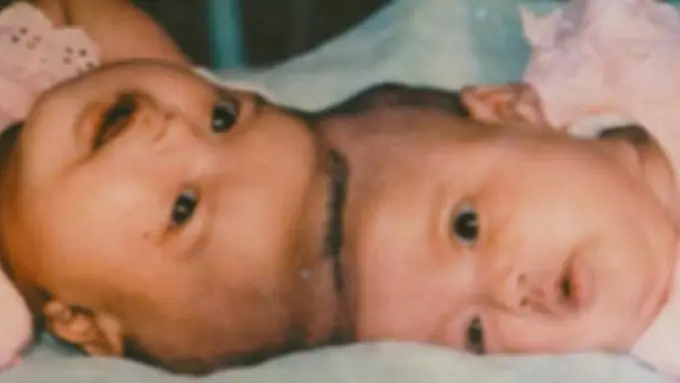 Masih Ingat Bayi Kembar Siam Ini? Sekarang Mereka Menjadi...