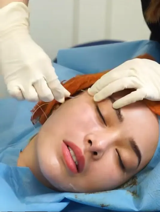 Namun Amanda Manopo menyebut prosedur agar punya pipi kurus ini justru tak sesakit yang dibayangkan. Bahkan tak sampai sejam namun hasilnya bisa dirasakan selama satu tahun. (Liputan6.com/IG/@amandamanopo)