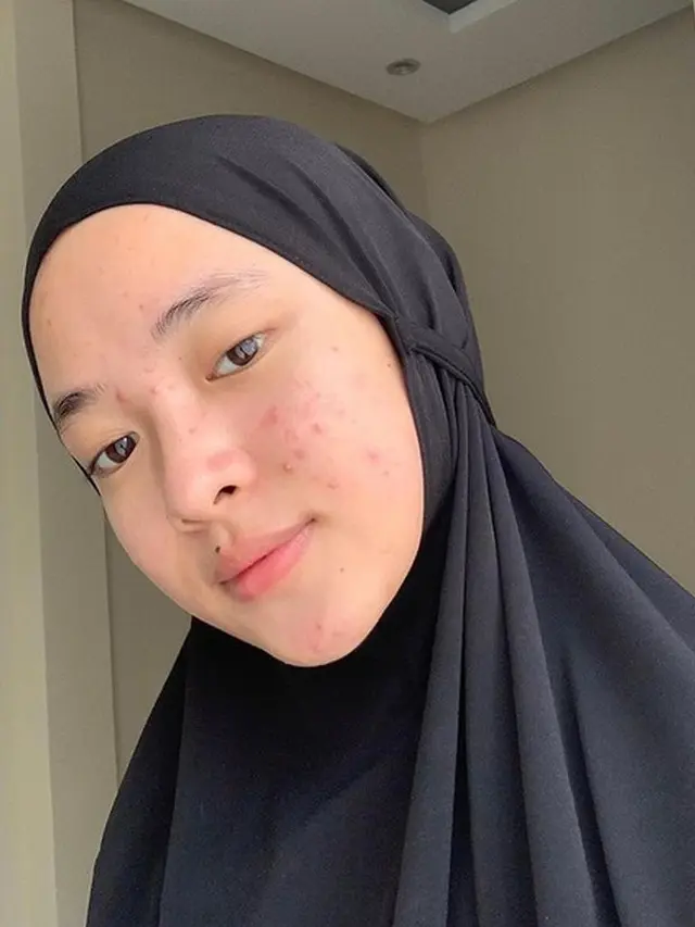 Potret 6 Seleb Unggah Foto Bare Face Lagi Berjerawat, Cintai Diri Sendiri Apa Adanya