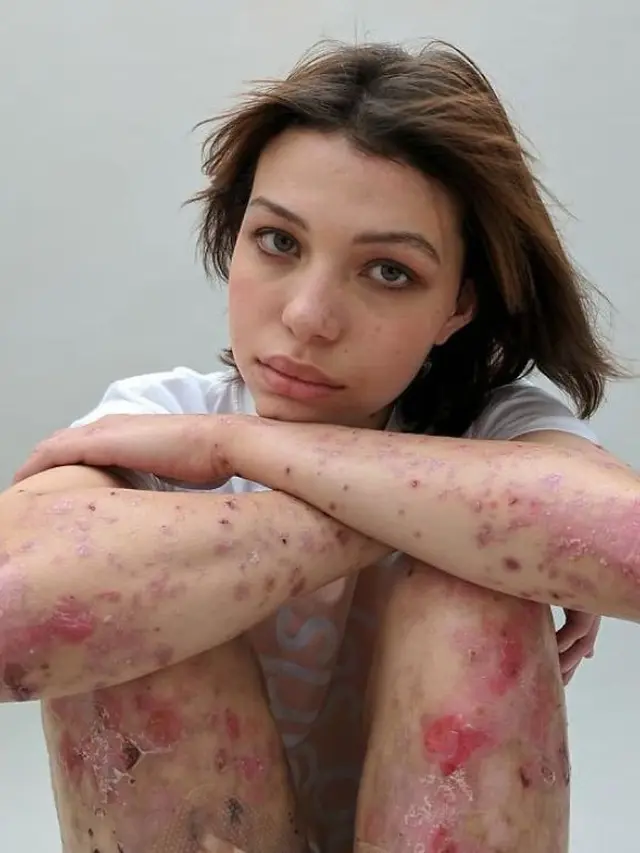 [Bintang] Cerita 5 Wanita dengan Bekas Luka di Tubuhnya, Bikin Terharu