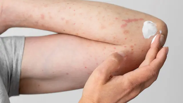 Chicken Skin (photo by freepik.com)