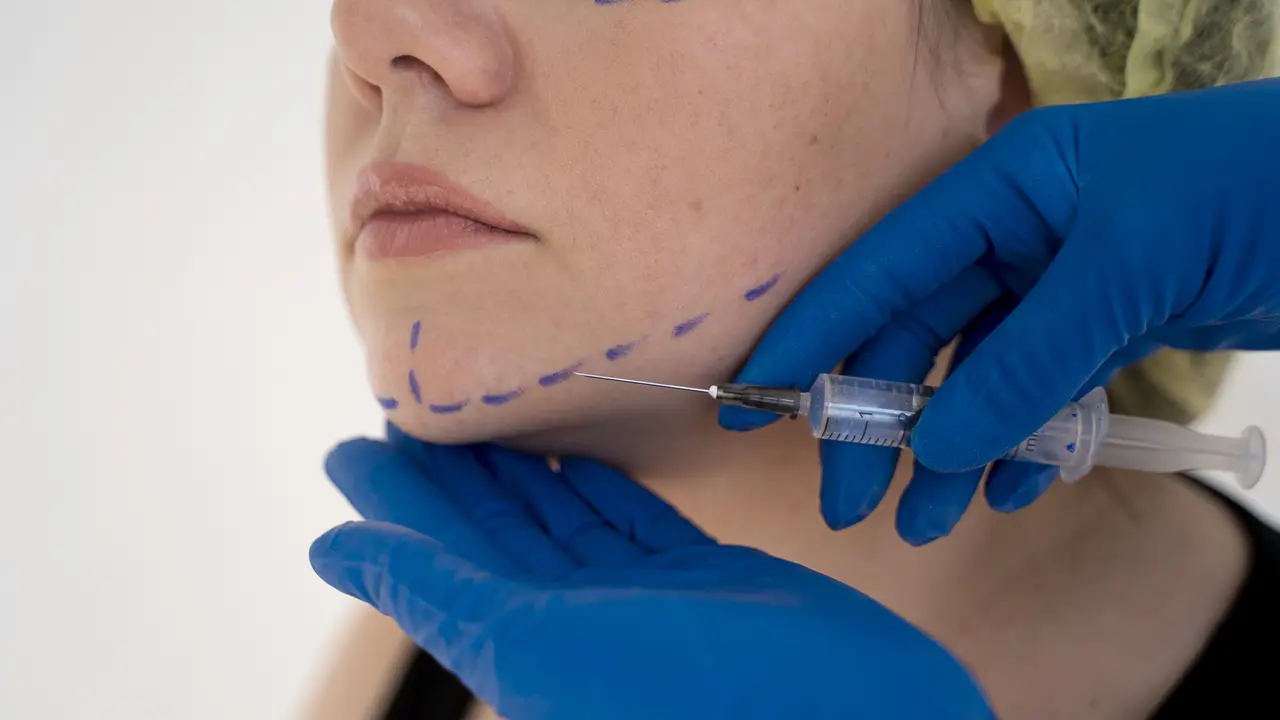Fat Transfer Manfaatkan Lemak Sendiri dalam Prosedur Estetik, Dokter: Lebih Aman Ketimbang Filler Sintetis