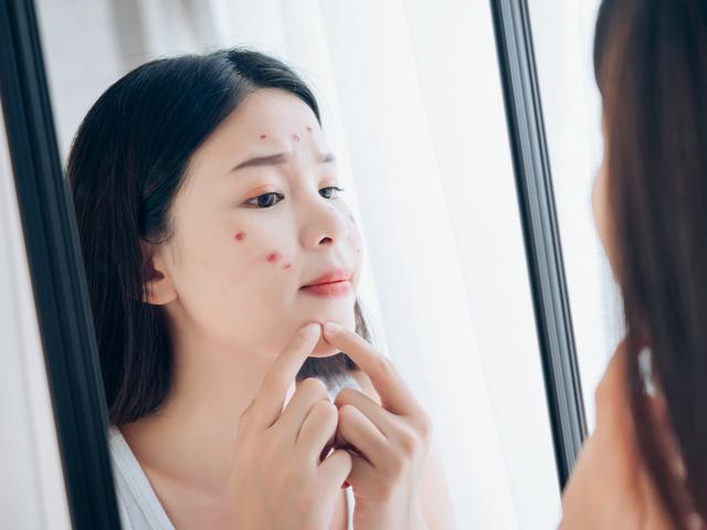 How to get rid of acne? Acne Skincare Poducts