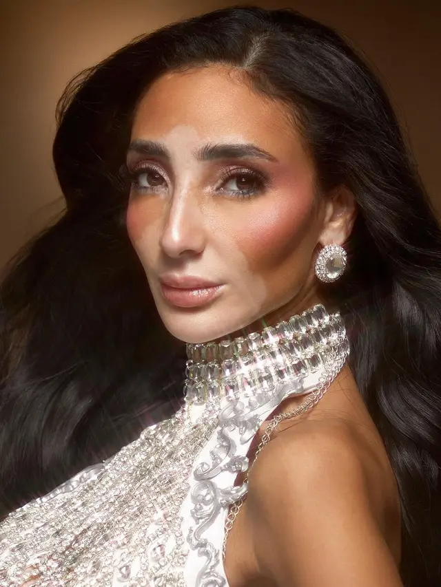 Wakil Mesir Jadi Finalis Miss Universe 2024 dengan Vitiligo Satu-satunya, Sempat Malu dengan Kondisi Kulitnya (hold)