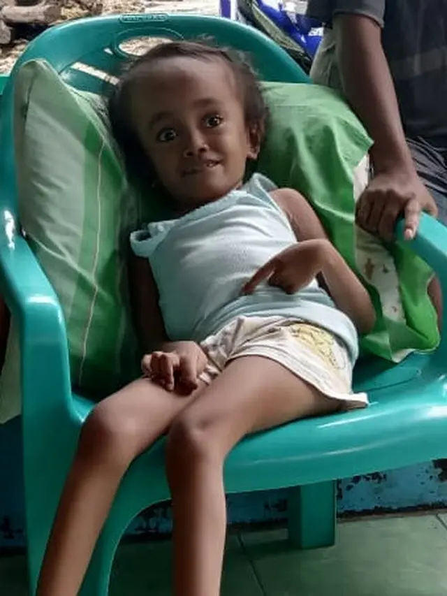 Bocah penderita Hidrosefalus