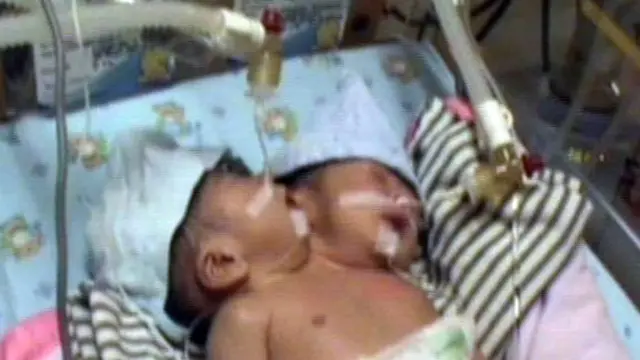 Tim Dokter Tak Akan Pisahkan Bayi Kepala 2 Cilacap