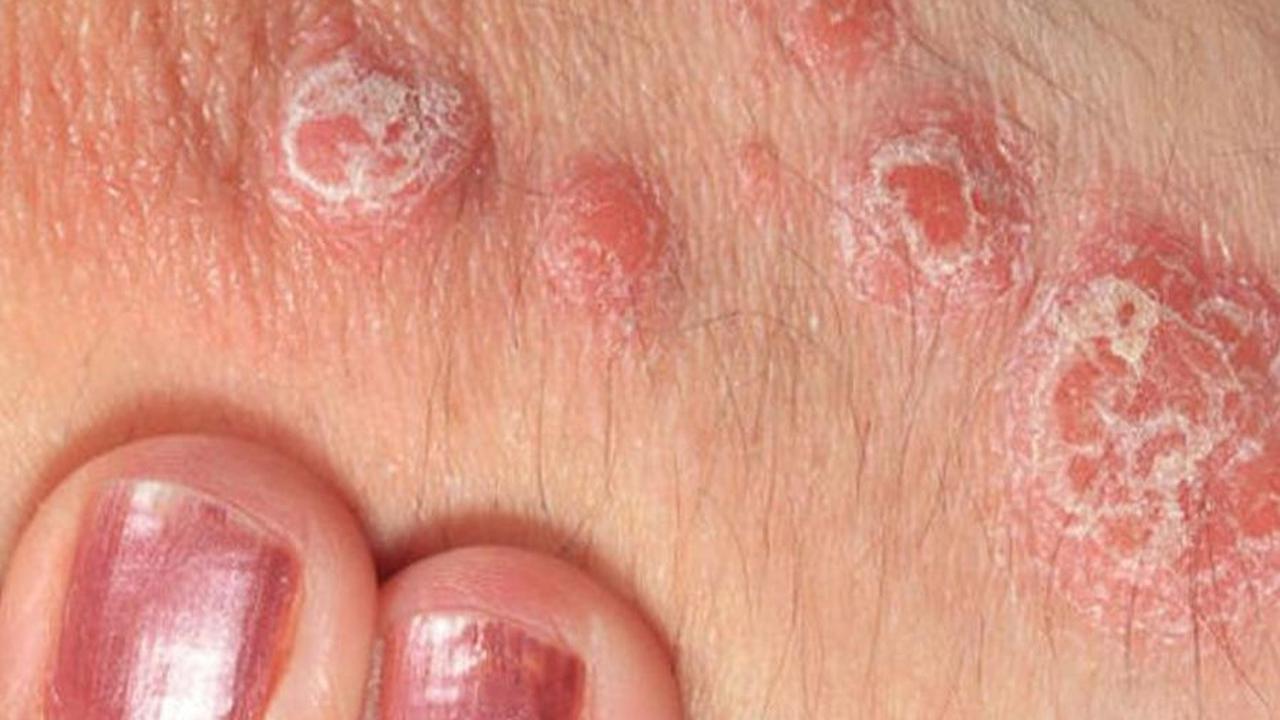 Pengertian Psoriasis Vulgaris