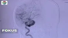 Kini terapi cuci otak menggunakan alat digital Subtraction Angiography (DSA) bisa dilakukan di RSPAD Gatot Subroto Jakarta Pusat.