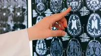 Ilmuwan Mampu Ganti Sel Otak Lama dengan Baru (Ilustrasi Otak/Pexels/Anna Shvets)