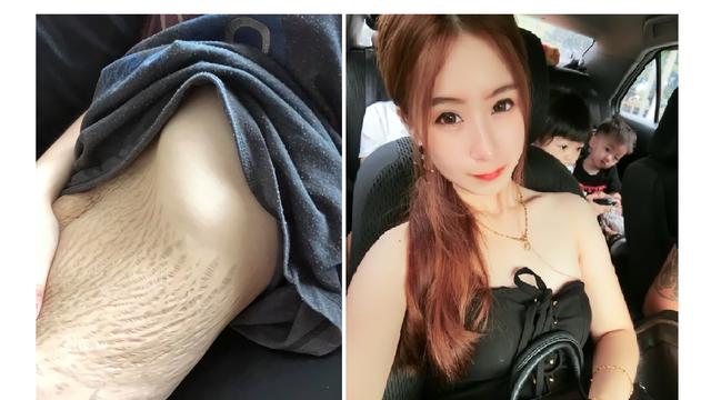 Unggah Foto Stretch Mark Ibu 4 Anak Dianggap Warganet Menjijikan Citizen6 Liputan6 Com