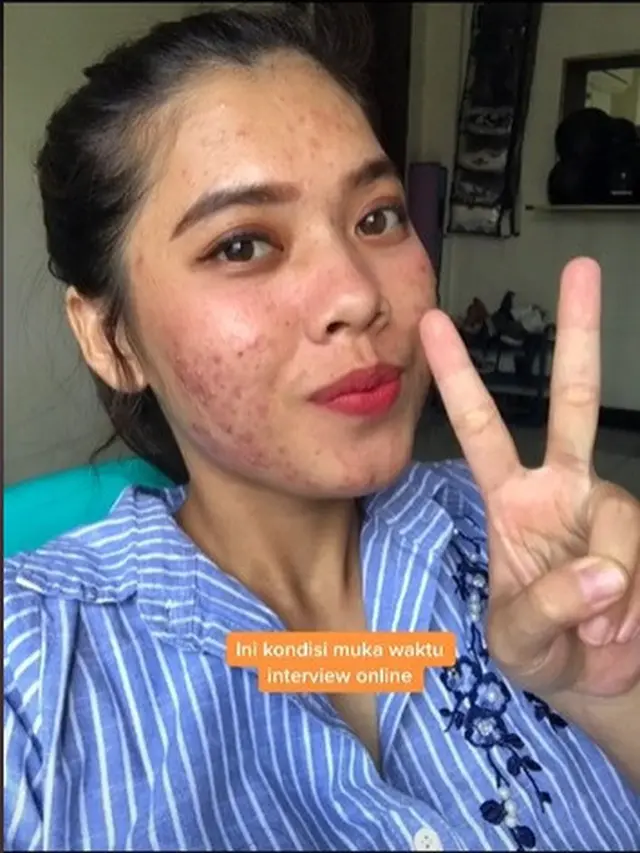 Gagal diterima kerja karena jerawat