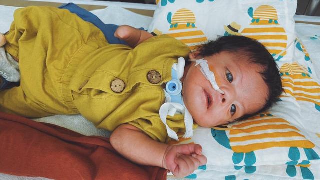 Hiro, Bayi Hiro, Moebius Syndrome, Kondisi Langka, Kondisi Tanpa Ekspresi, Tanpa Ekspresi, Bayi