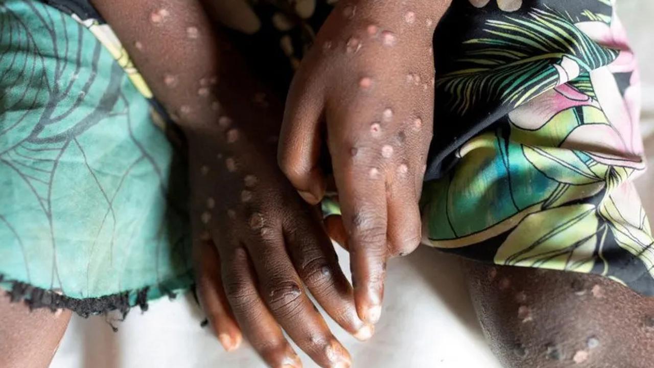 Kenali Kondisi Ruam yang Kerap Muncul pada Pasien Mpox