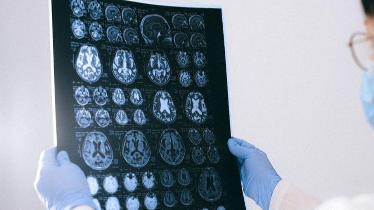 Bahaya Serangan Pasca-Stroke, Komplikasi Mematikan yang Perlu Diwaspadai