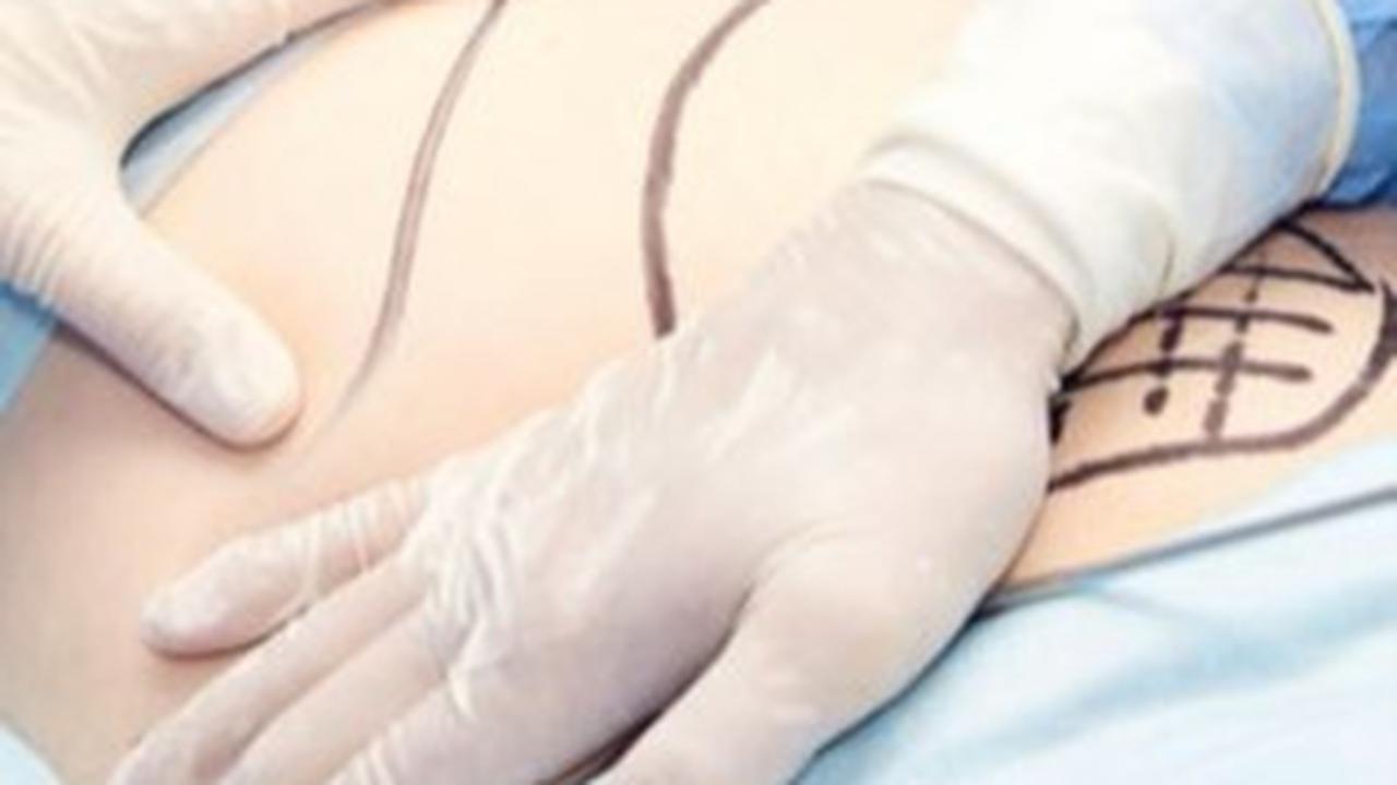 Heboh Selebgram Meninggal Setelah Sedot Lemak, Prosedur Ini Harus Ditangani Dokter Spesialis Bedah