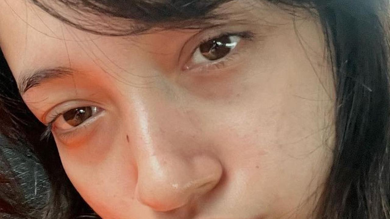 Megan Domani juga menyebut dirinya sebagai acne fighter. Acne Fighter merupakan sebutan untuk orang yang mengalami masalah kulit berjerawat yang cukup serius, hingga bisa berdampak buruk terhadap mental seseorang.