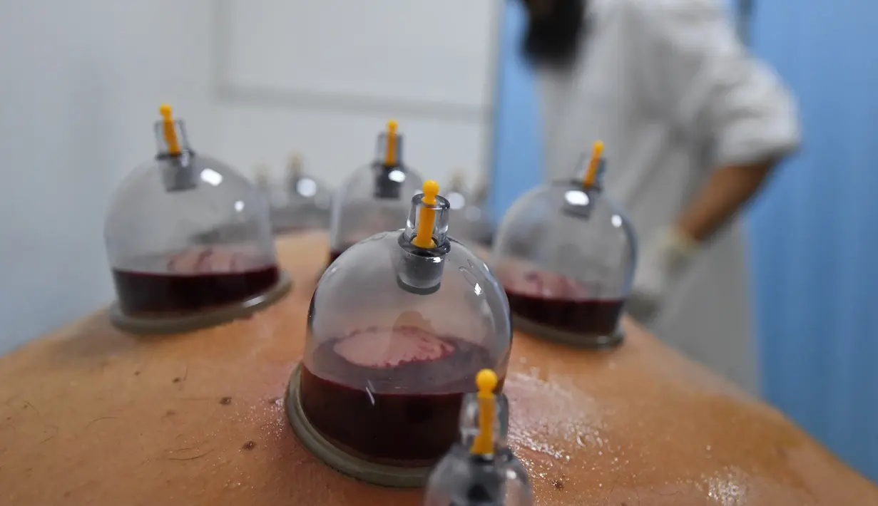 Spesialis melakukan pengobatan hijama atau terapi bekam basah kepada pasien di sebuah klinik di Ajman, Uni Emirat Arab, Kamis (15/8/2019). Terapi ini masih digunakan di negara-negara Asia seperti China, Pakistan, Iran, dan dunia Arab. (KARIM SAHIB/AFP)