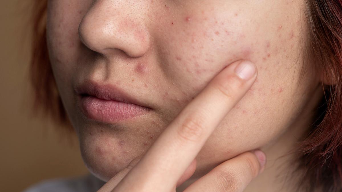 9 Cara Mengatasi Wajah Alergi Skincare, Gunakan Bahan Alami Berikut Ini
