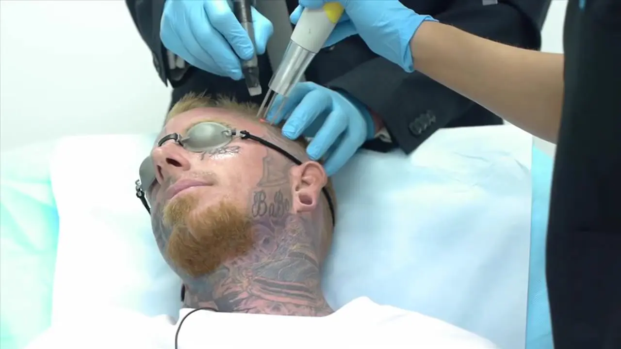 Begini Caranya Menghapus Tattoo Dengan Teknologi Laser