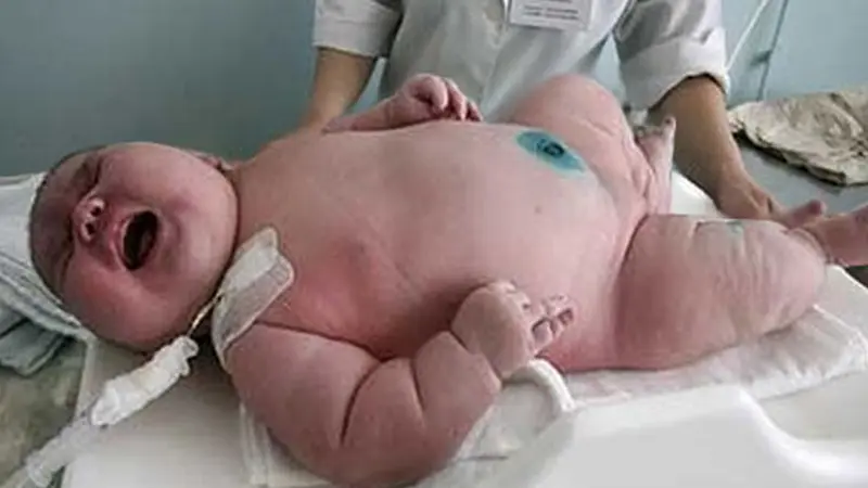 Menakjubkan, Wanita dengan Bobot 272 Kg Ini Lahirkan Bayi Raksasa