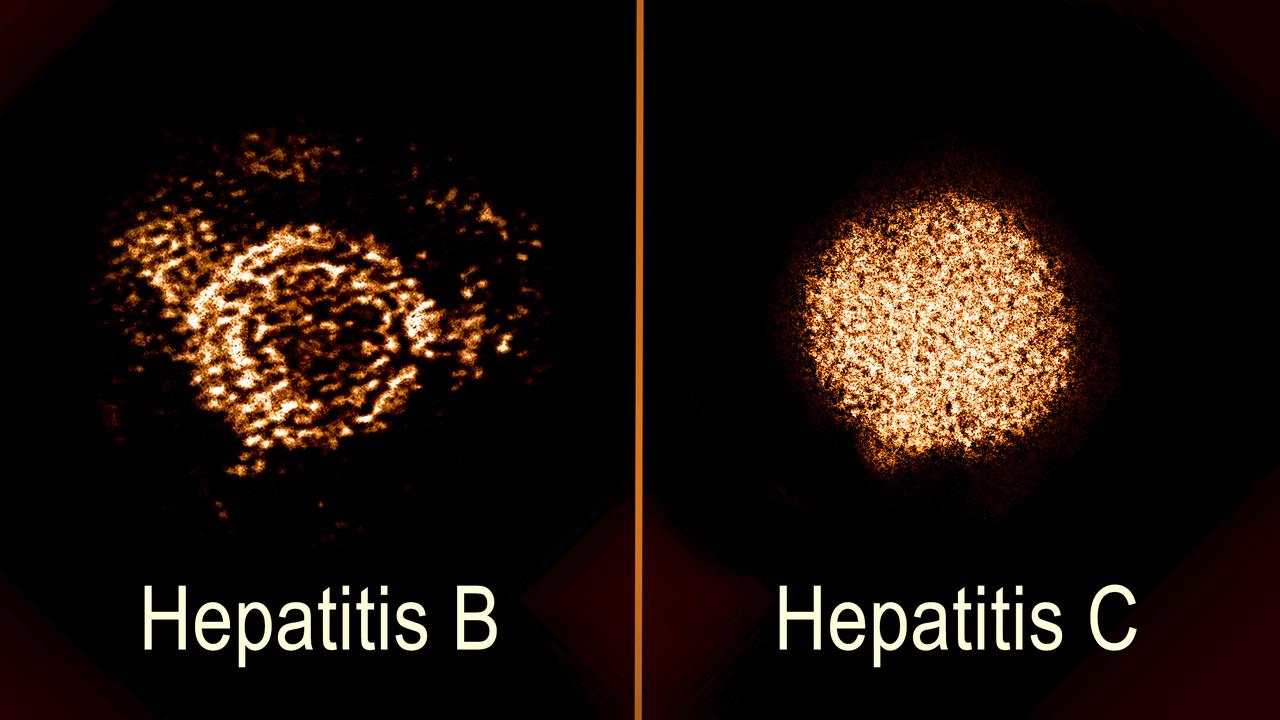 hepatitis b dan c