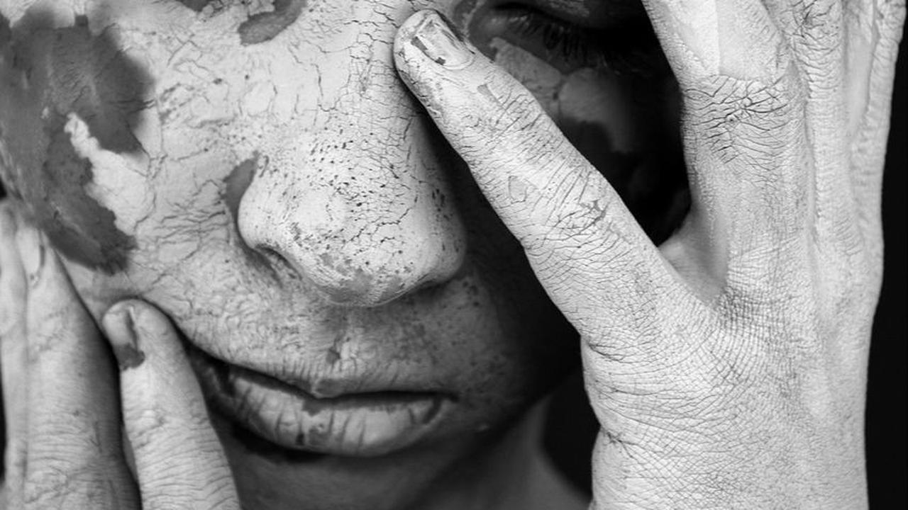 Cara Menyembuhkan Vitiligo