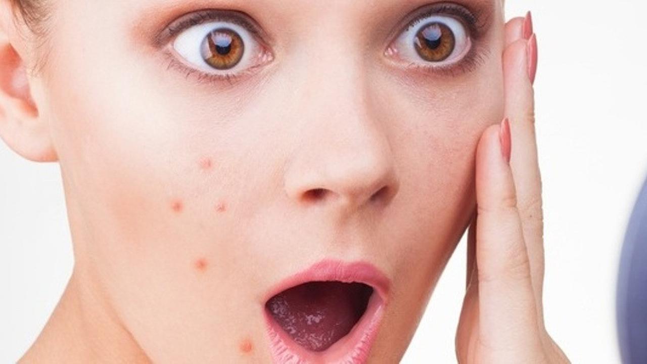 Cara Menghilangkan Jerawat