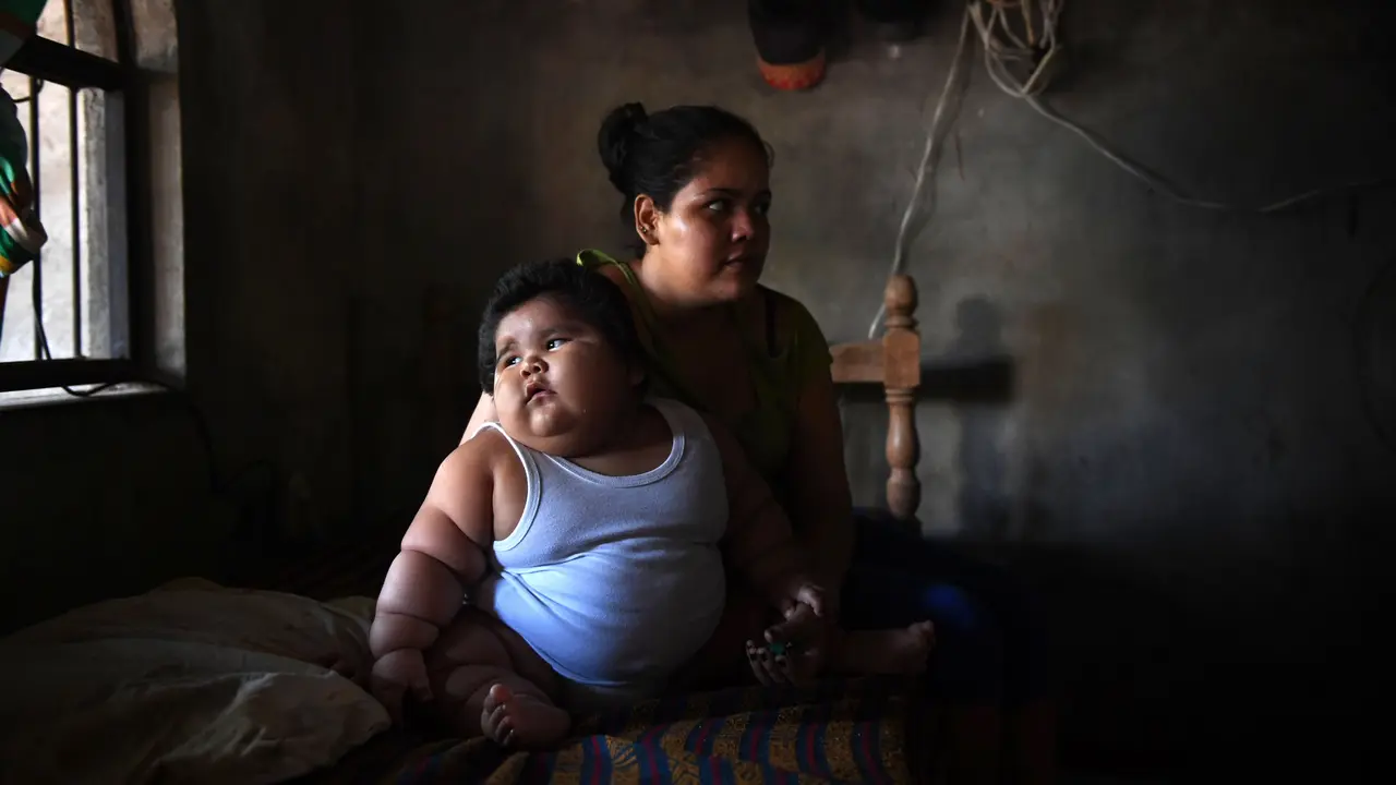 Berat 28 Kg, Bayi 10 Bulan di Meksiko Alami Obesitas