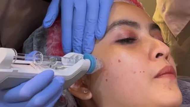 Minim Rasa Sakit, Skinbooster Injeksi Ini Mampu Perbaiki Kerusakan Kulit dan Mencerahkan Wajah