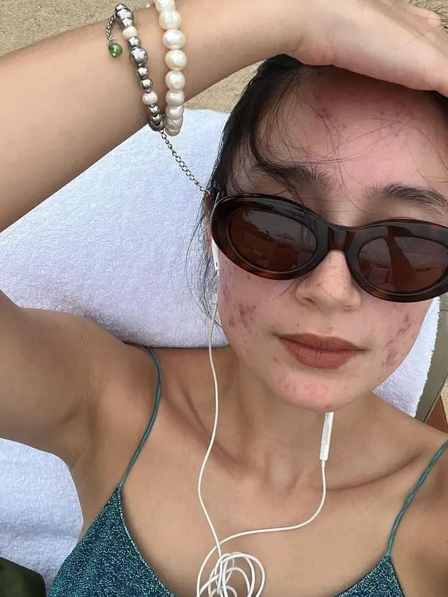 Tatjana Sapira mengunggah foto wajah penuh jerawat[instagram/tatjanasaphira]