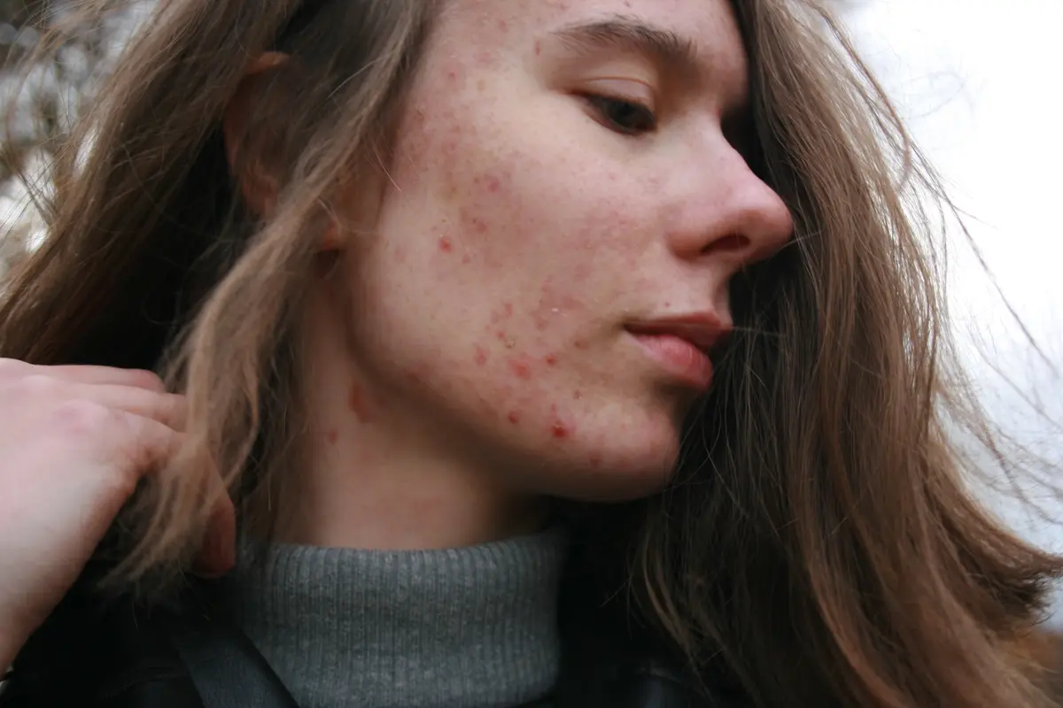 5 Alasan Konsumsi Gula Berlebih Menyebabkan Jerawat (Foto: Unsplash/Barbara Krysztofiak)
