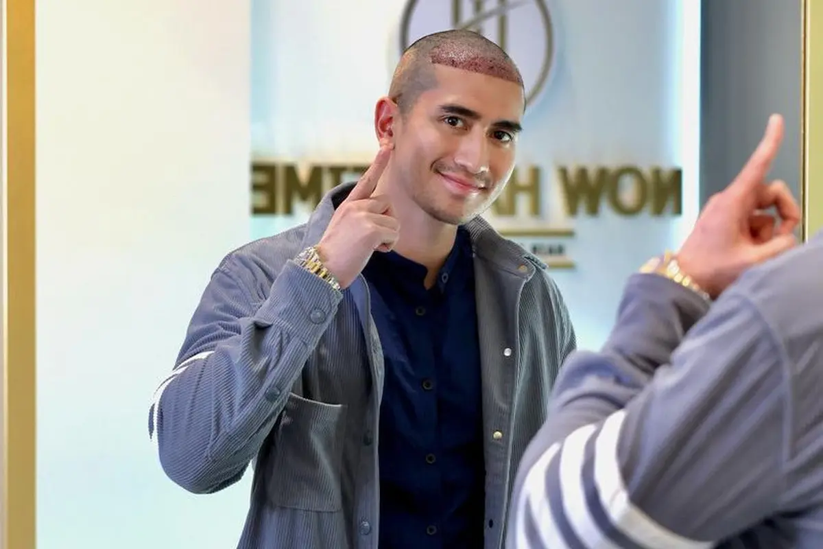 Verrell Bramasta lakukan Hair Transplant