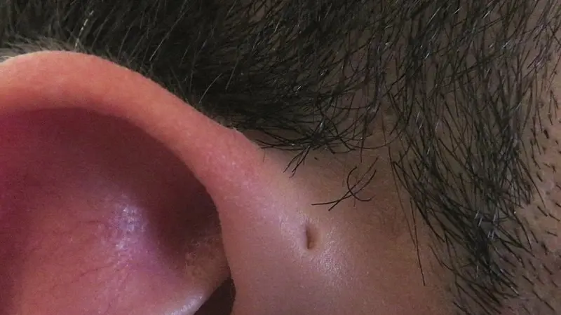 Sinus Preauricular