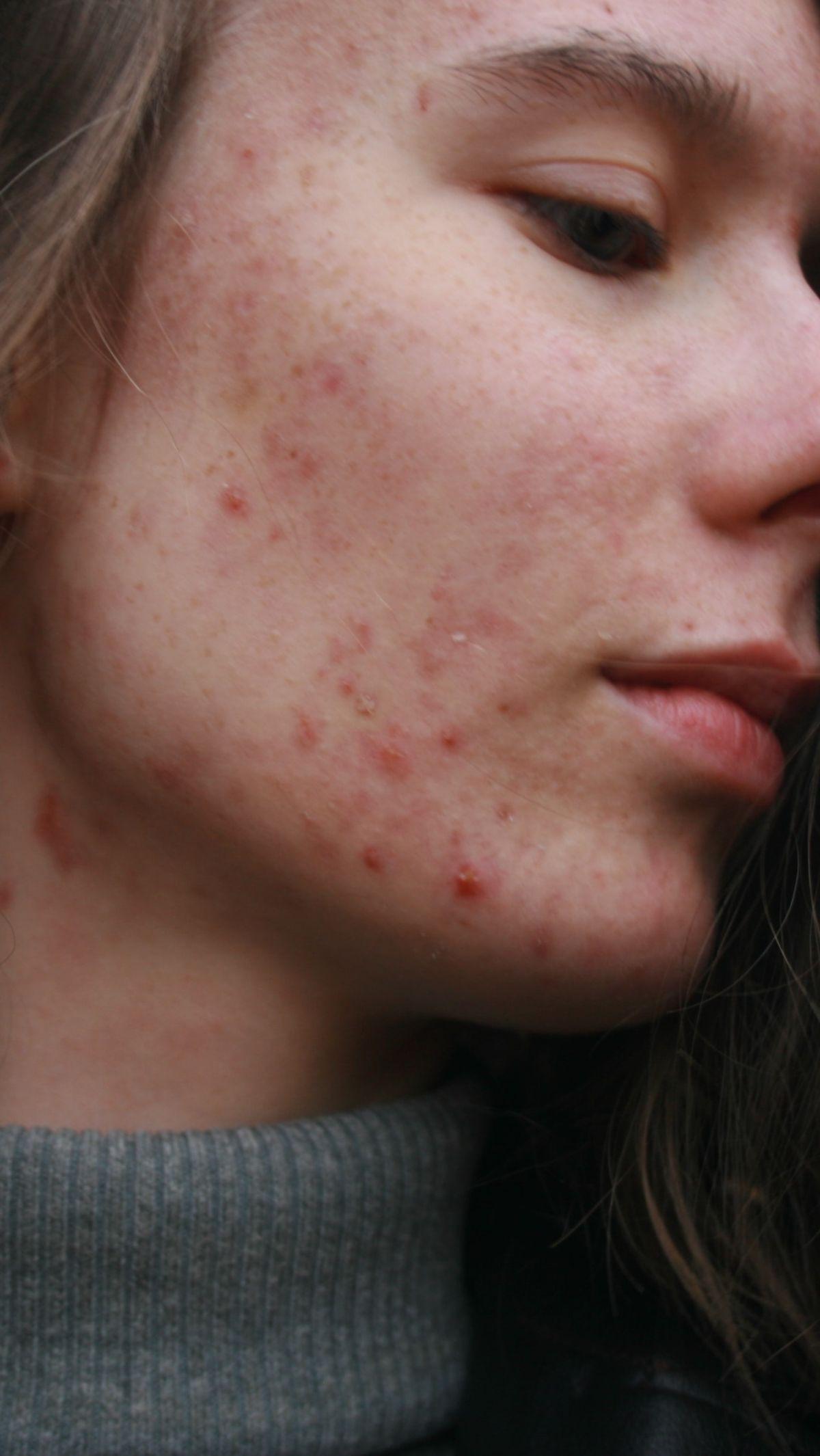 <b>2. Inflammatory Spots</b><br>