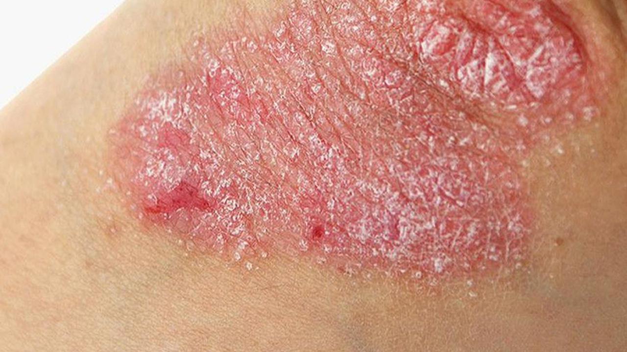 Metode Pengobatan Psoriasis Vulgaris