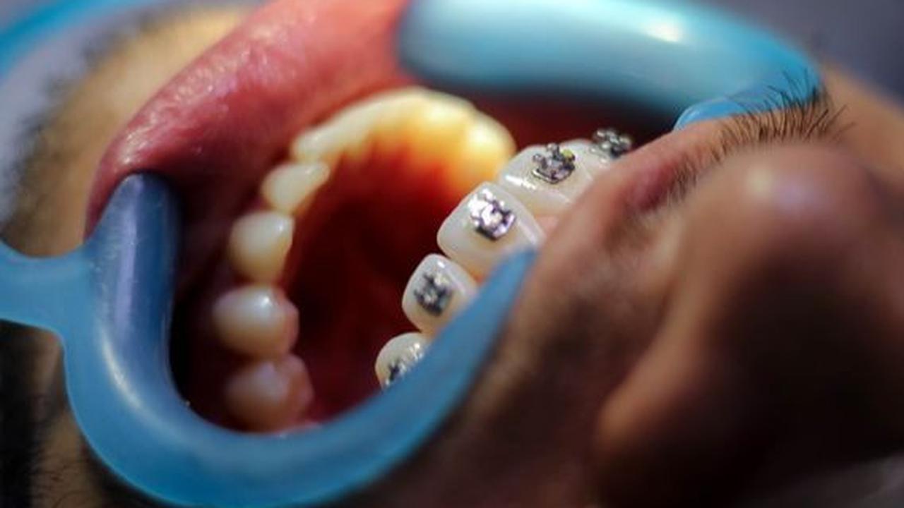 Manfaat Retainer Gigi