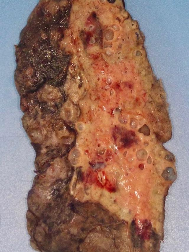 Seram, Penampakan Paru-Paru Wanita Muda yang Rusak Akibat Virus Corona