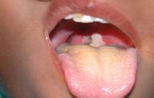 4 Fakta Pamekasan Waspada Penyakit Difteri, Paling Banyak Menyerang Anak-anak, Sudah Ada Korban Meninggal