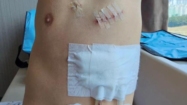 Luka bekas operasi pelatih Timnas Indonesia, Shin Tae-yong