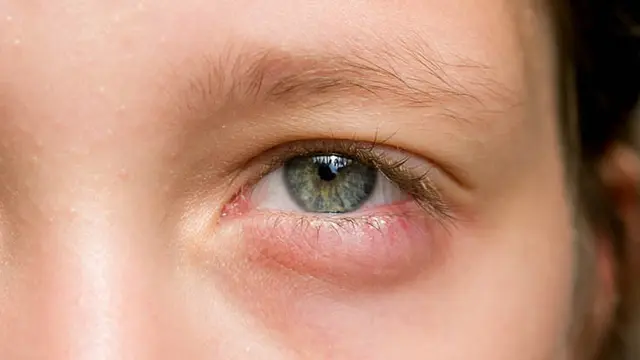 [Bintang] Ngaku Suka Pakai Softlens, Hati-hati Jangan Terjadi 4 Hal Ini