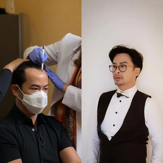 Potret Transformasi 6 Artis Usai Jalani Transplantasi Rambut, Kevin Aprilio-Atta Halilintar