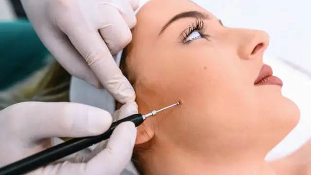 Ilustrasi Menghilangkan Tahi Lalat