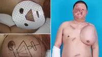  Seorang dokter sedang berusaha untuk menumbuhkan wajah baru di dada seorang pria yang terluka parah ketika ia tersengat listrik.